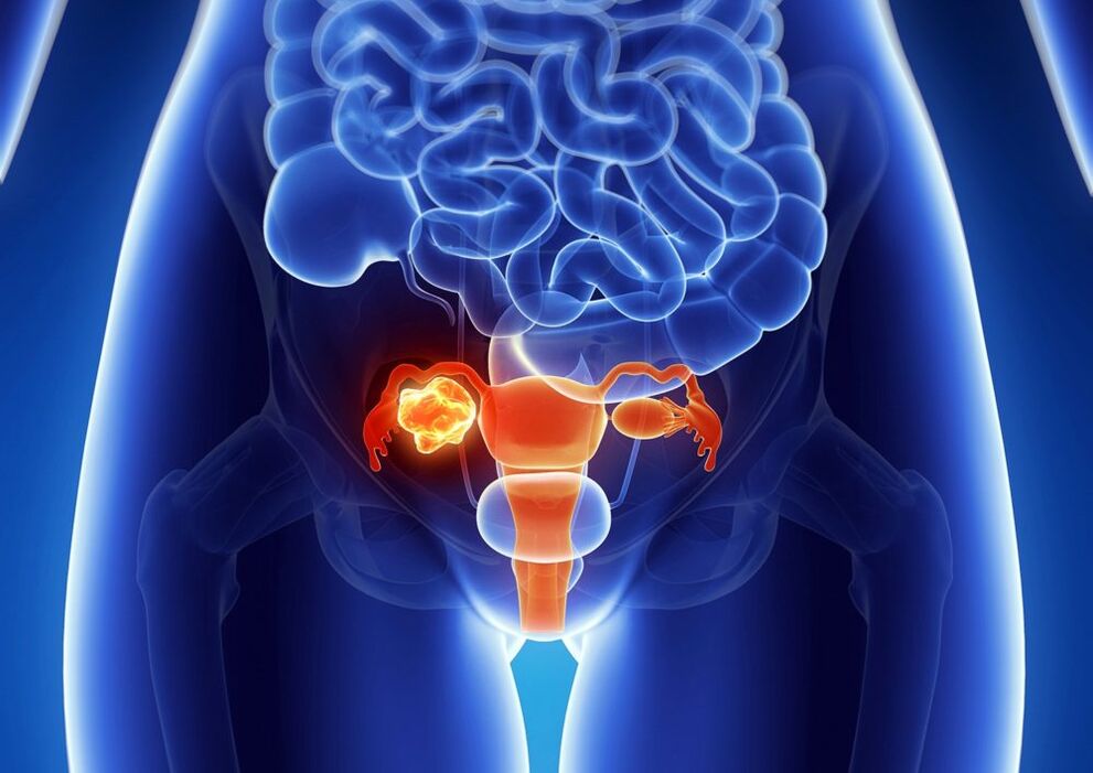 Woman ovary pathology under the influence of alcohol